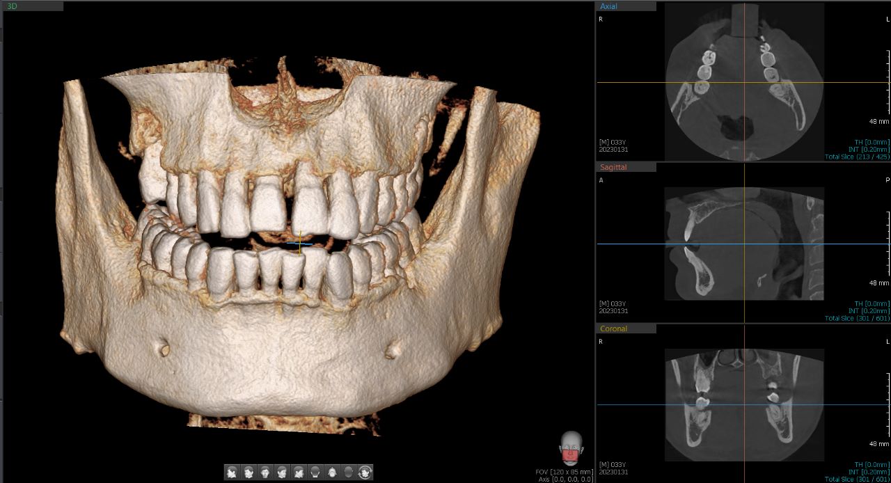 Tomógrafo Dental Vatech Green X12 - CT 12 x 8.5 cm